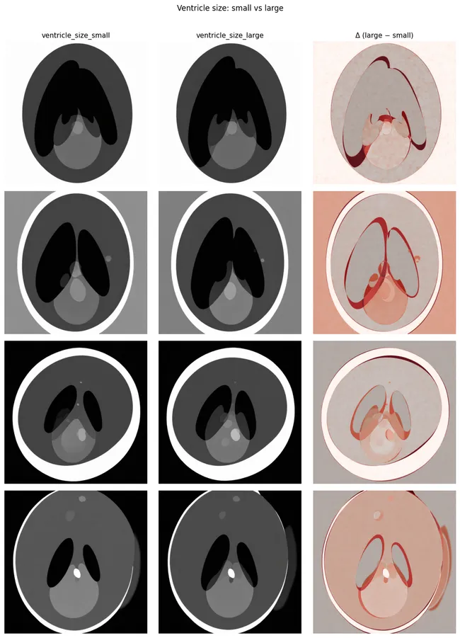 Generation from the same seed but asking different ventricle sizes in the prompt